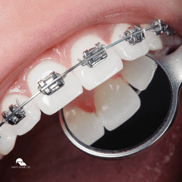 Close-up dental braces on teeth. Orthodontic Treatment